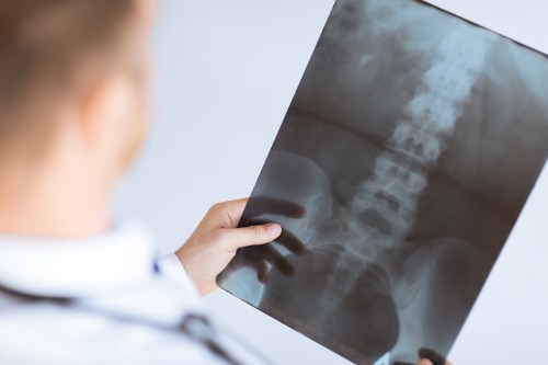 Understanding Spinal Cord Injuries and the Need for Legal Representation