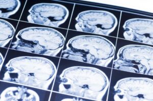 How to Prove Negligence in Brain Injury Cases