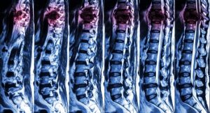 Dealing with Insurance Companies After a Spinal Cord Injury