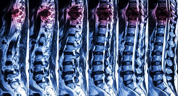 Dealing with Insurance Companies After a Spinal Cord Injury